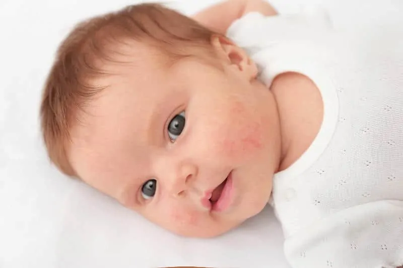 грижи за бебета с атопичен дерматит