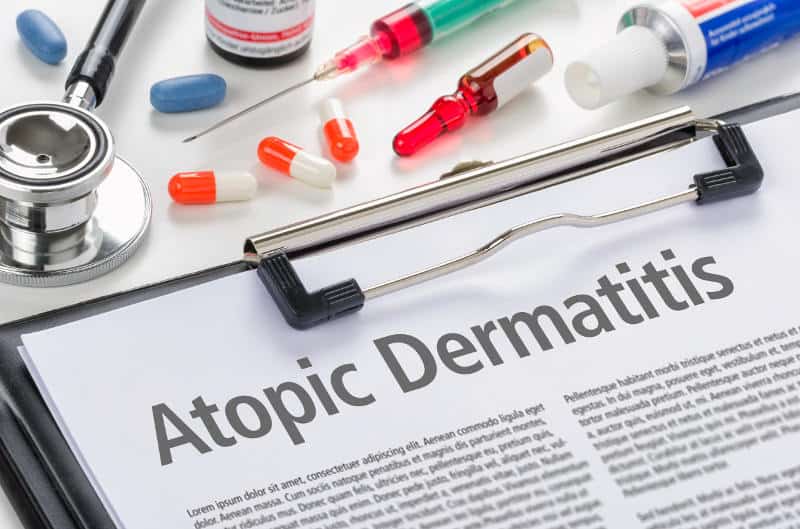 Атопичен дерматит – разбулване на митовете