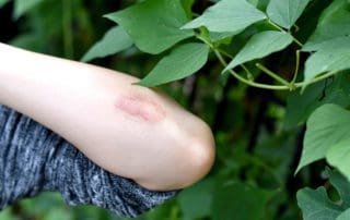 алергичен контактен дерматит