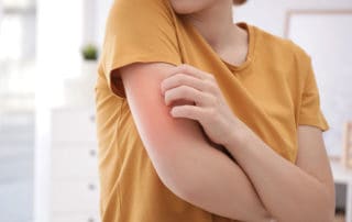 Лятна екзема