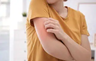 Лятна екзема