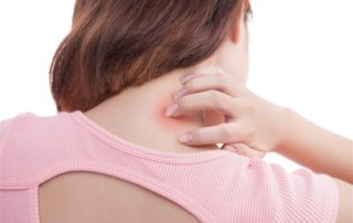 Себореен дерматит през лятото