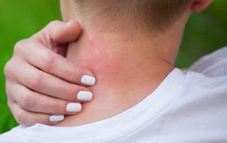 Алергия от насекоми