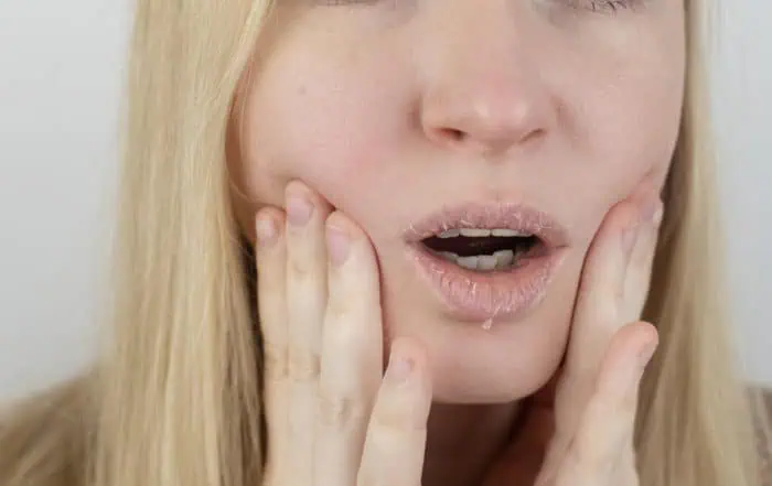 eczema on the lips