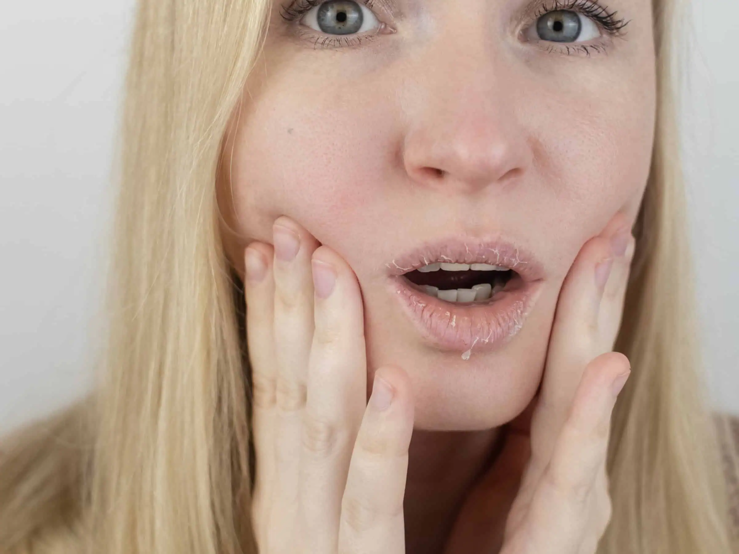 eczema on the lips