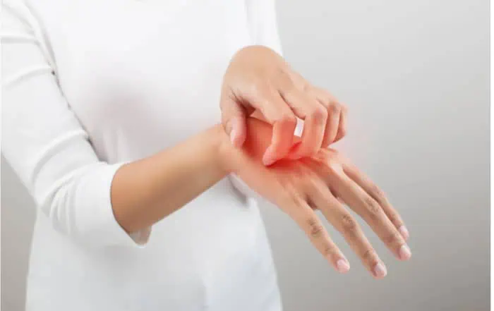 хронична екзема на ръцете