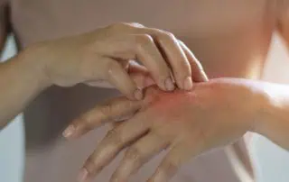 екзема по ръцете