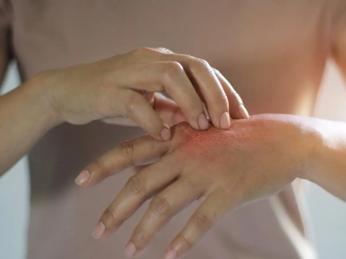 екзема по ръцете