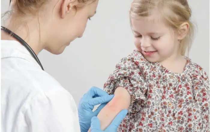 детски атопичен дерматит