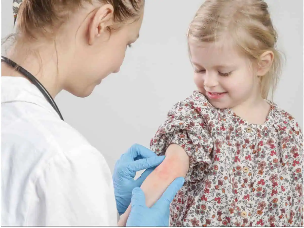 детски атопичен дерматит