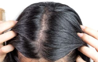 себорея на скалпа