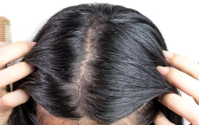 себорея на скалпа