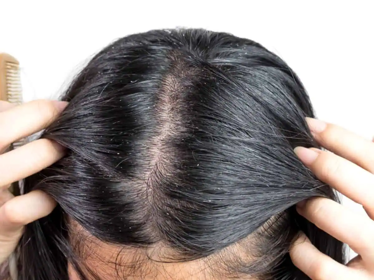 себорея на скалпа