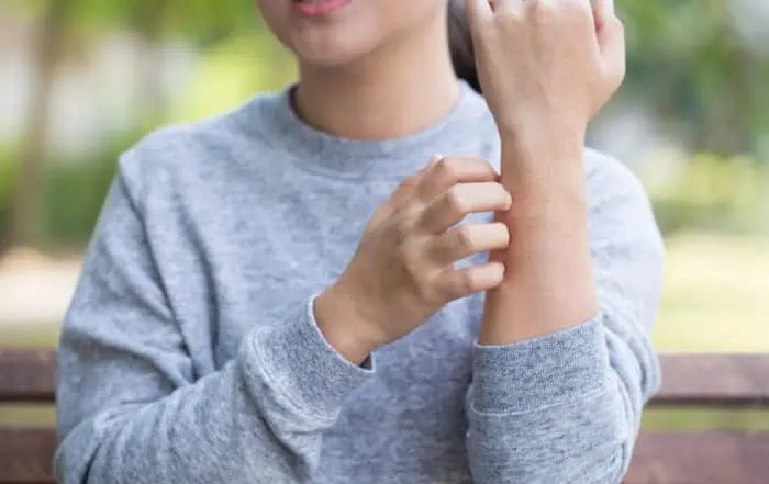 студова екзема