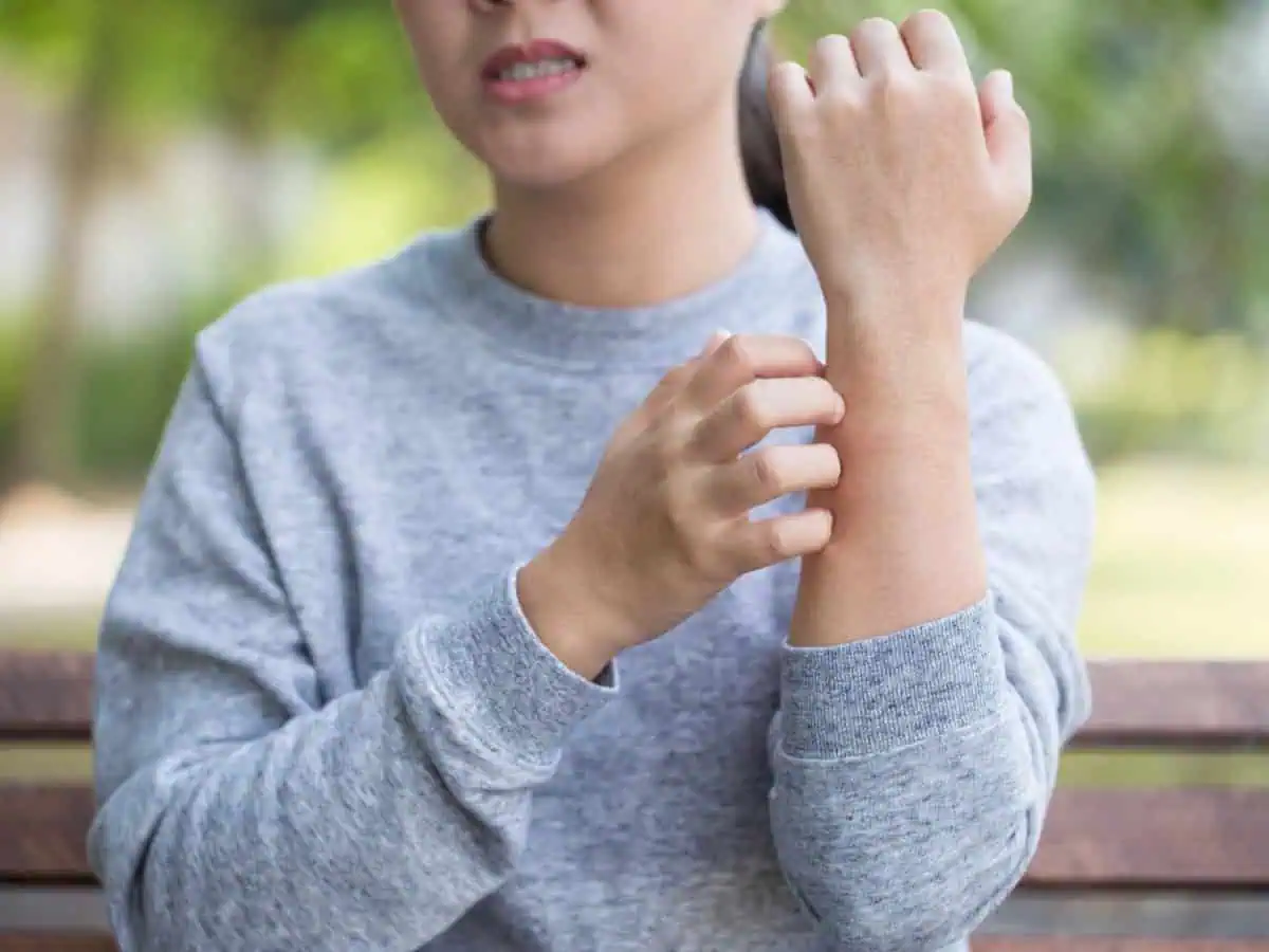 студова екзема