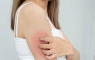 От какво се причинява себорейният дерматит