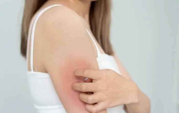 От какво се причинява себорейният дерматит