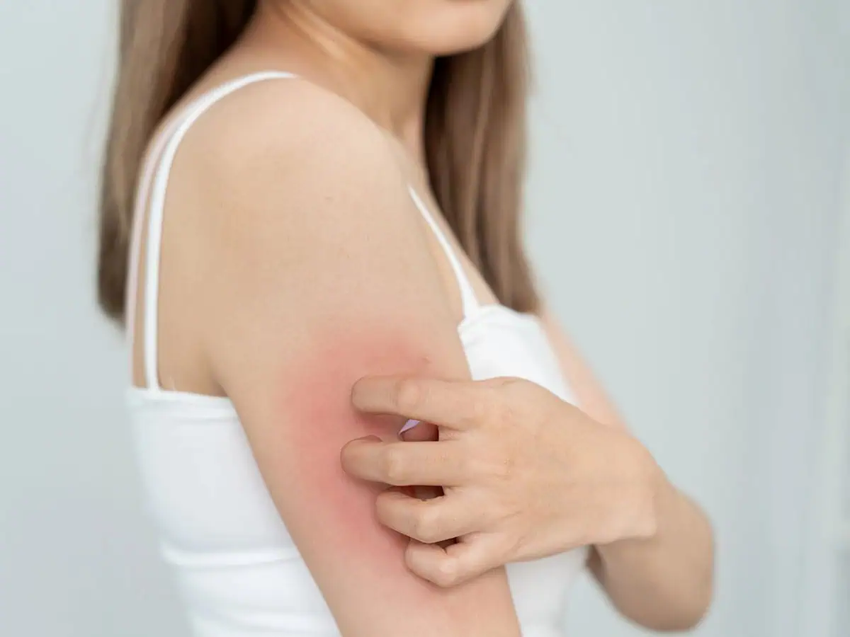 От какво се причинява себорейният дерматит