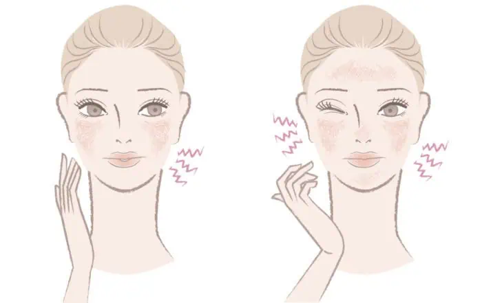 имам екзема по лицето