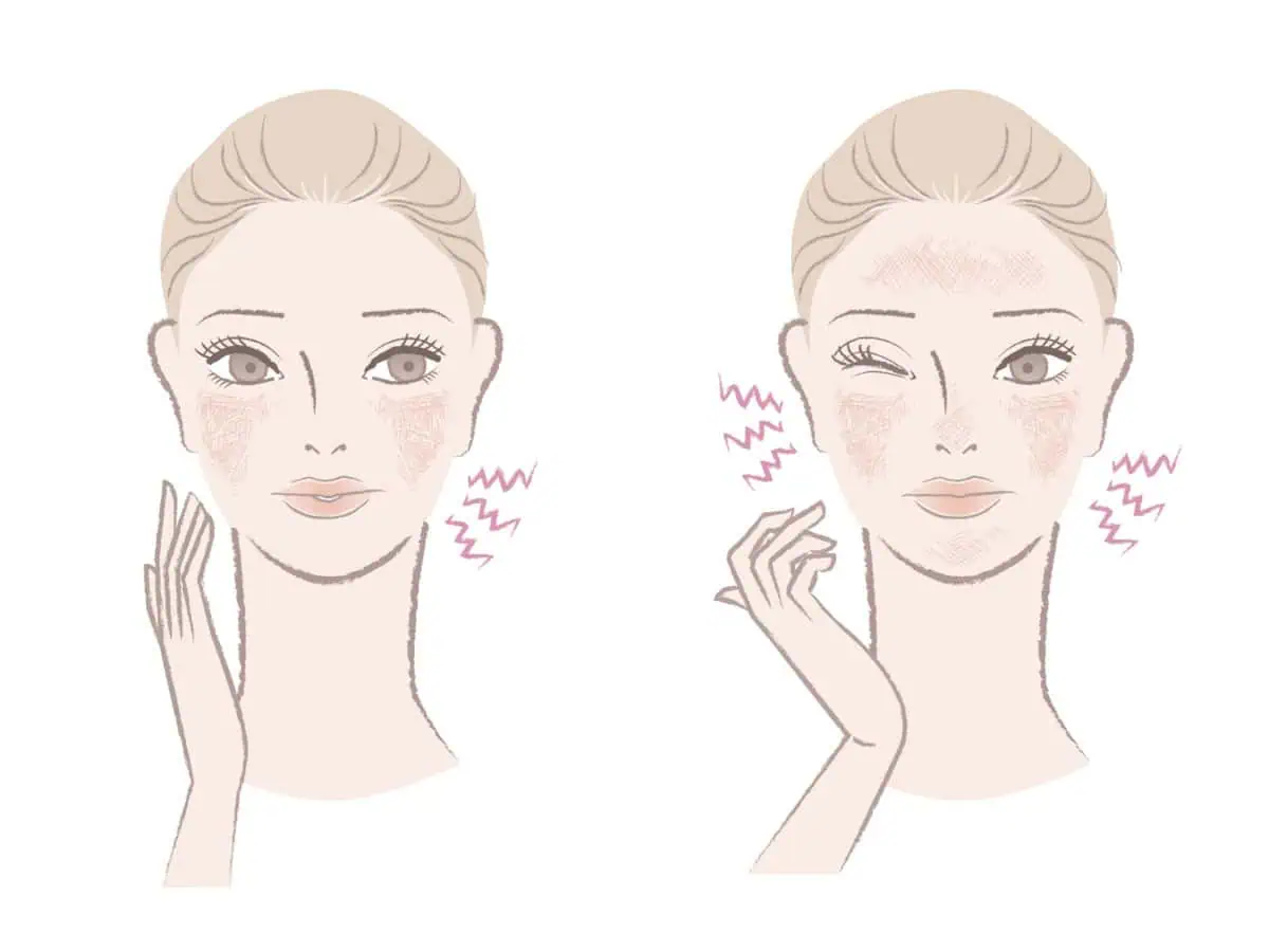 имам екзема по лицето