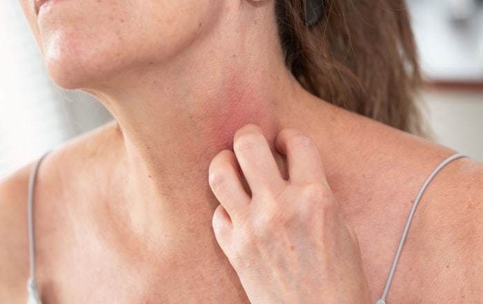 Контактен дерматит