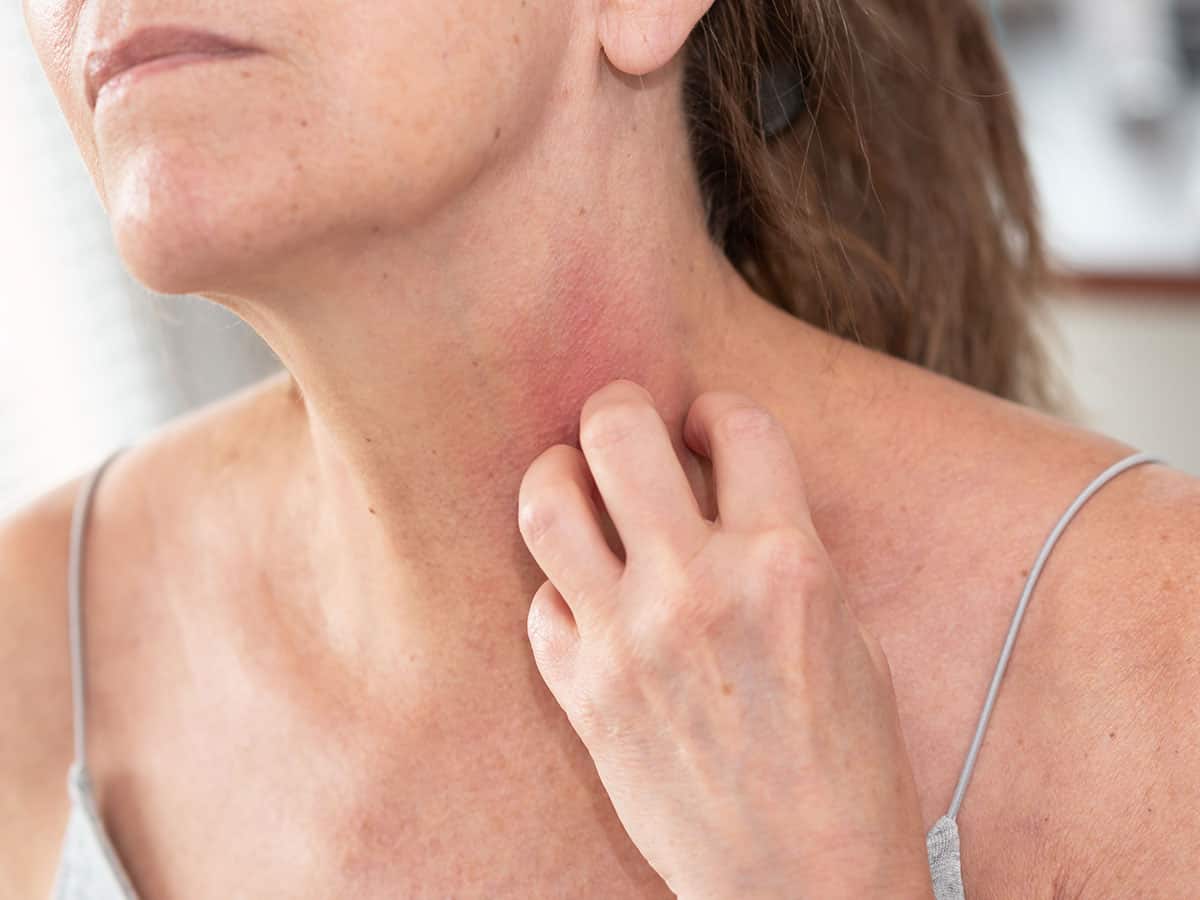 Контактен дерматит